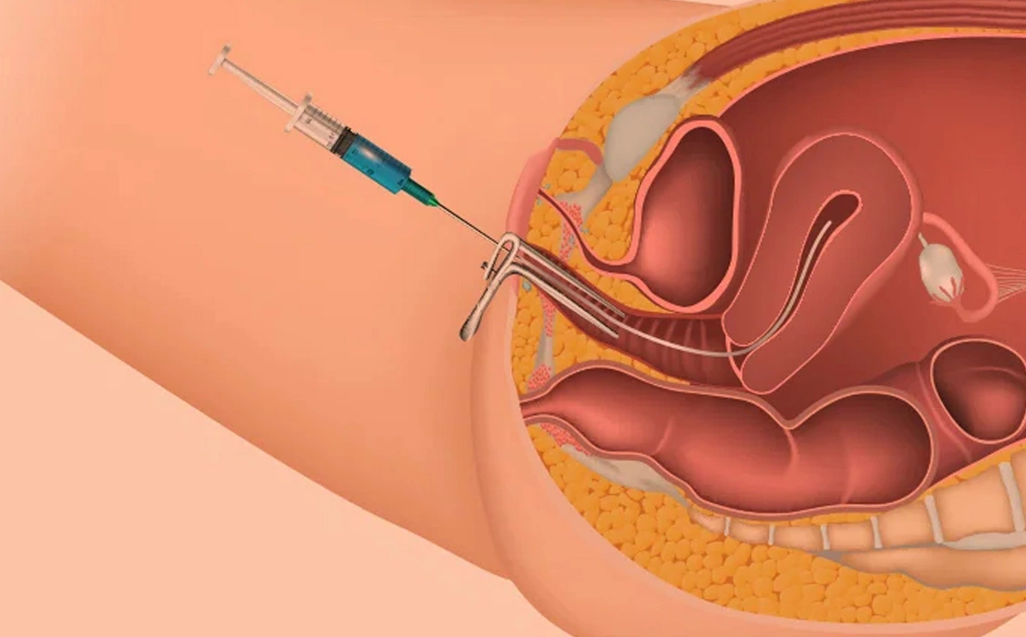 IUI Treatment