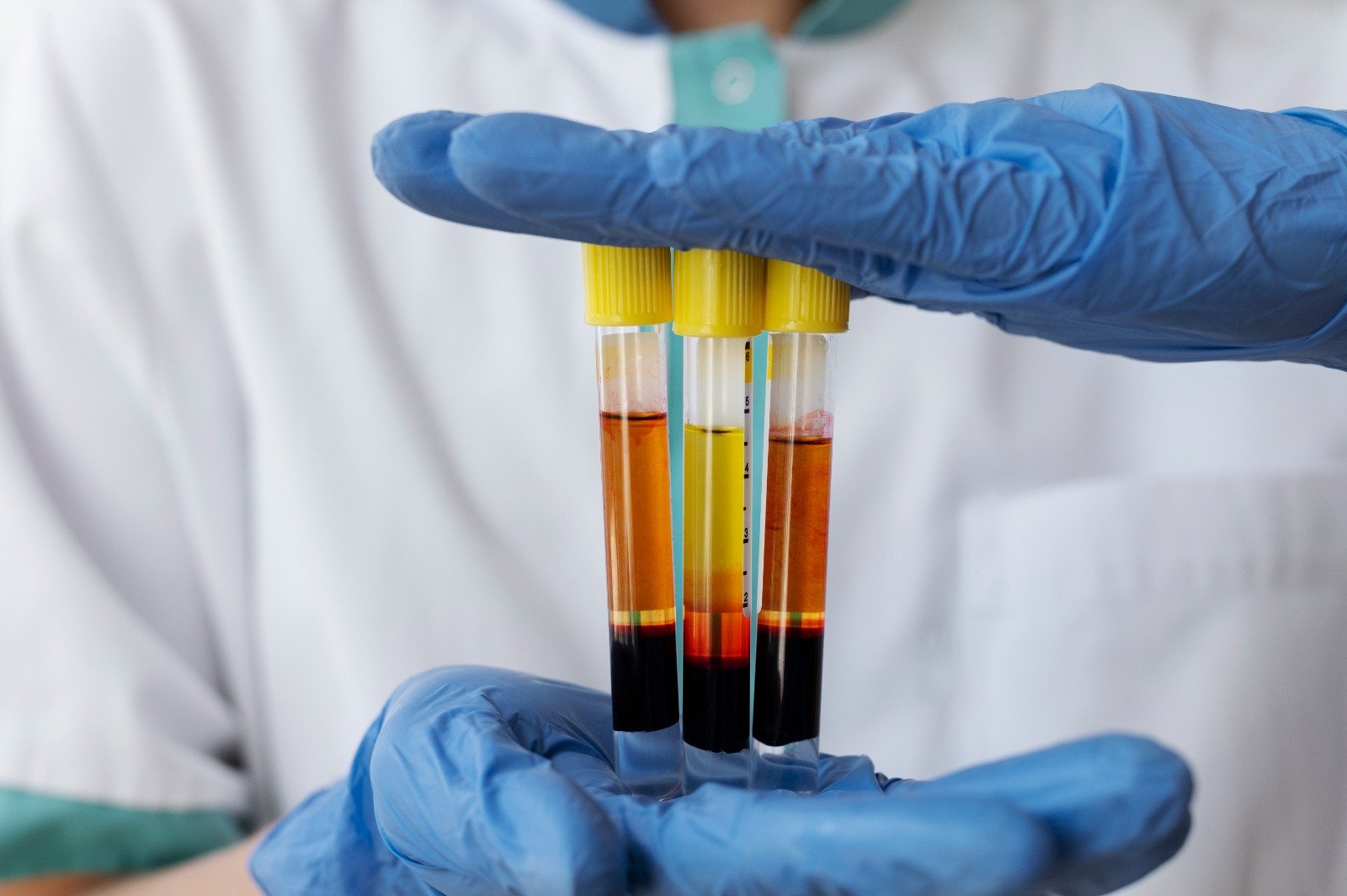 PRP Therapy